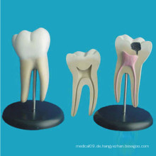 Menschliche pathologische molare Zähne Anatomisches Modell für die Lehre (R080103)